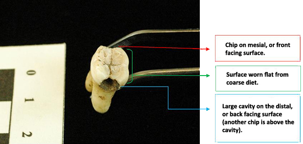 Molar being held in a pair of forceps. The molar has a large cavity on the distal surface apparent as a hole in the tooth.