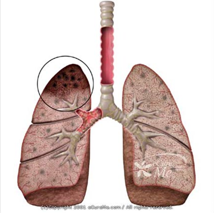 Drawing of a pair of human lungs with one lung showing signs of tuberculosis.